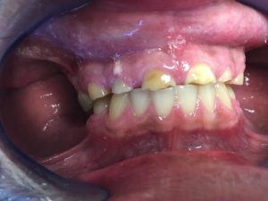 Denture - Before and After Photos