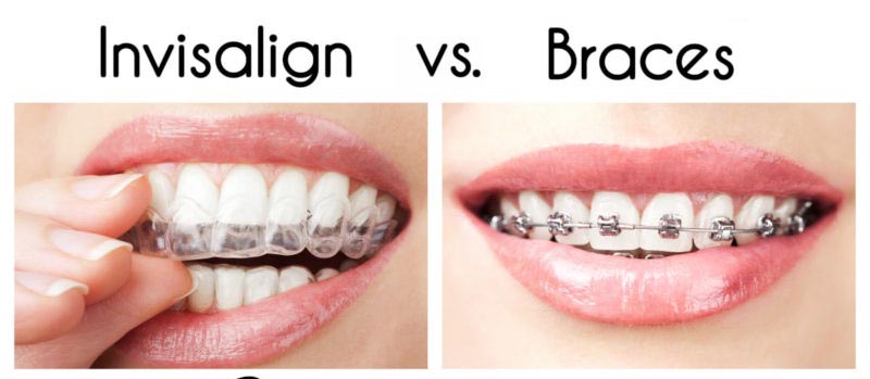 Affordable Invisalign – Dentist Near Me Dental Office in Hayward