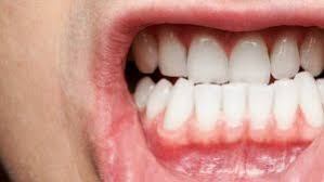 GUM-DISEASE-2.jpg