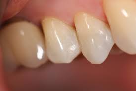 Tooth-colored-filling-overtaking-amalgam.jpg