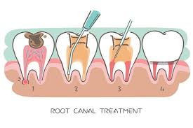 root-canals.jpg