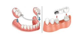 Dentures Advantages and Disadvantages.jpg