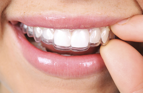 Invisalign Cost Vacaville, CA  Affordable Invisalign Treatment