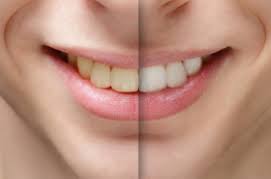 Causes-of-Dark-Teeth.jpg