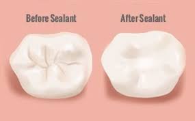 Dental-Sealants.jpg