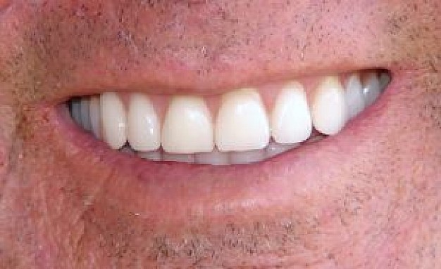  Dentures-and-Partials.jpg