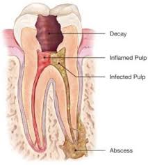  Root-Canal-Treatment.jpg