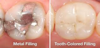 Tooth-Colored-Fillings.jpg